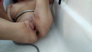 Lizzy Yum - Lizzy Yum Post Op bawdy cleft And Verification
